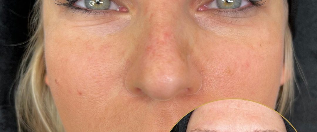 Pilar Mille Micropigmentation